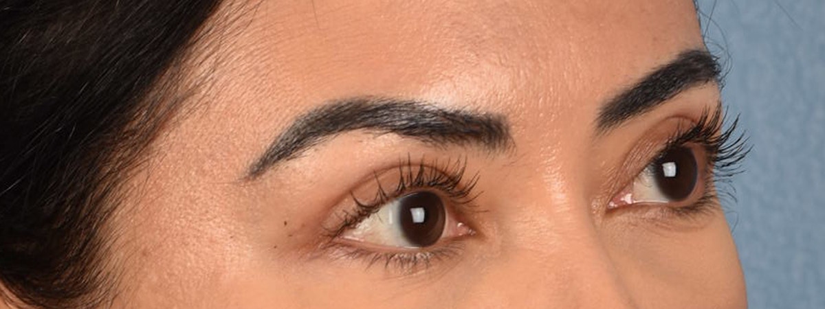 Blepharoplasty Before & After Gallery - Patient 181625 - Image 4