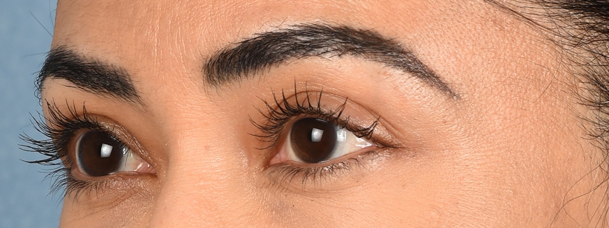 Blepharoplasty Before & After Gallery - Patient 181625 - Image 5