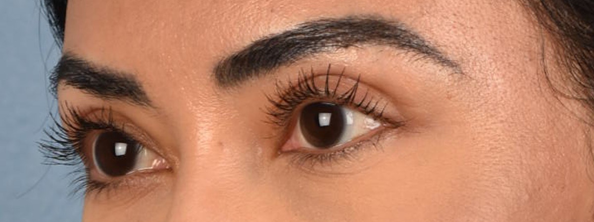 Blepharoplasty Before & After Gallery - Patient 181625 - Image 6