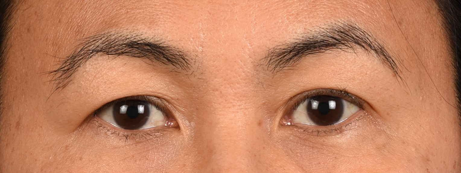 Blepharoplasty Before & After Gallery - Patient 374478 - Image 1
