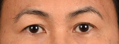 Blepharoplasty Before & After Gallery - Patient 374478 - Image 1