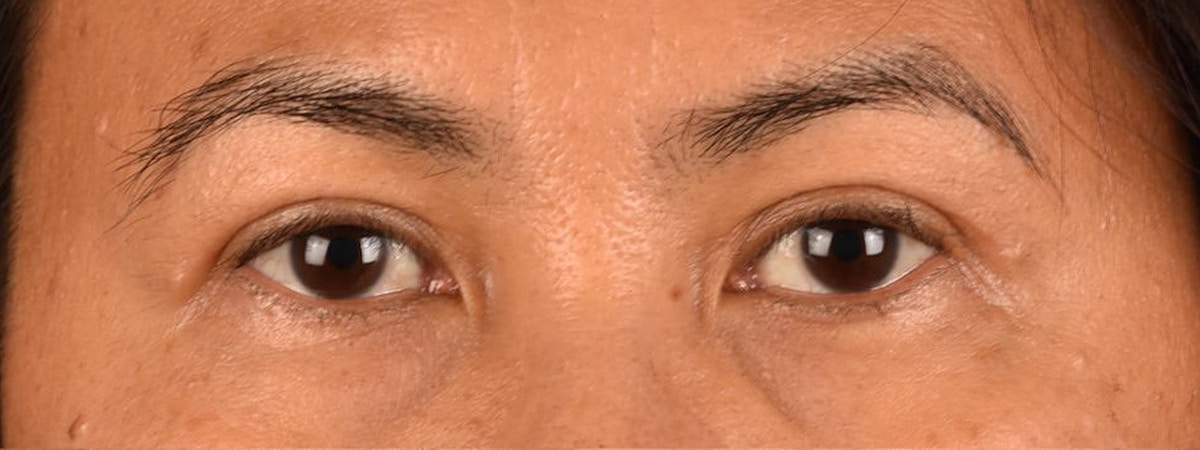 Blepharoplasty Before & After Gallery - Patient 374478 - Image 2