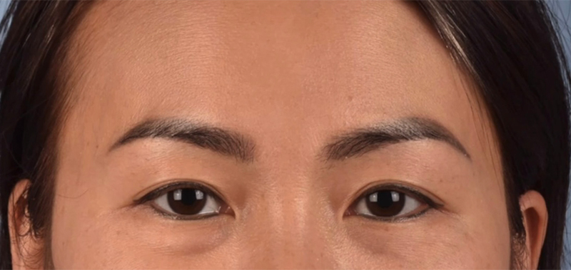 Blepharoplasty Before & After Gallery - Patient 301798 - Image 1