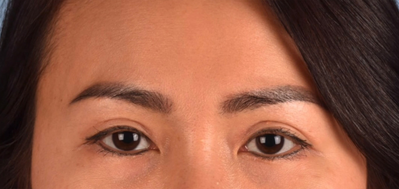 Blepharoplasty Before & After Gallery - Patient 301798 - Image 2