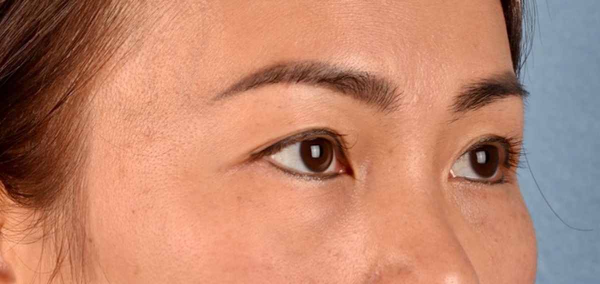 Blepharoplasty Before & After Gallery - Patient 301798 - Image 3