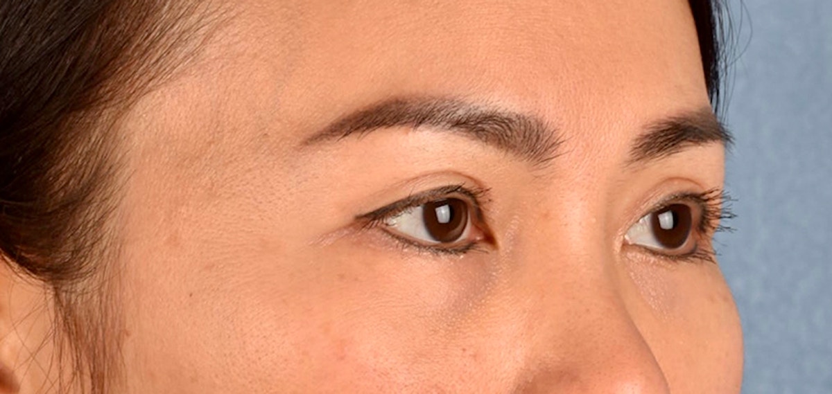 Blepharoplasty Before & After Gallery - Patient 301798 - Image 4