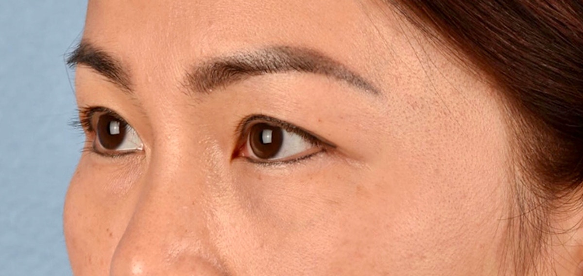 Blepharoplasty Before & After Gallery - Patient 301798 - Image 5