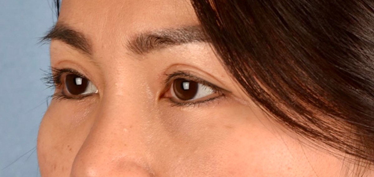 Blepharoplasty Before & After Gallery - Patient 301798 - Image 6