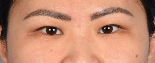 Hidden Patients Before & After Gallery - Patient 181350 - Image 1