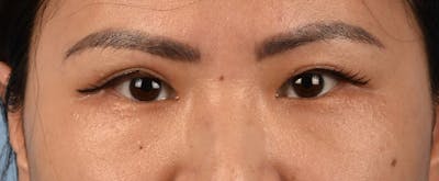 Hidden Patients Before & After Gallery - Patient 181350 - Image 2