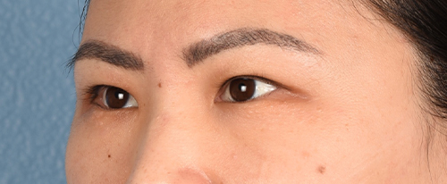 Hidden Patients Before & After Gallery - Patient 181350 - Image 3