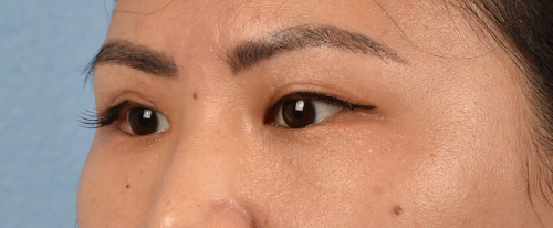 Hidden Patients Before & After Gallery - Patient 181350 - Image 4