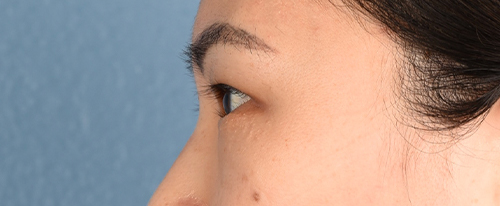 Hidden Patients Before & After Gallery - Patient 181350 - Image 5