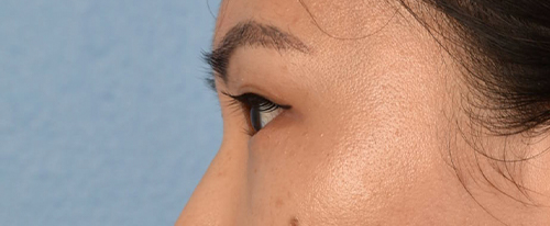 Hidden Patients Before & After Gallery - Patient 181350 - Image 6