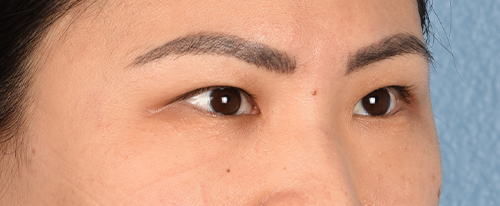 Hidden Patients Before & After Gallery - Patient 181350 - Image 7