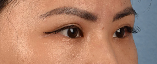 Hidden Patients Before & After Gallery - Patient 181350 - Image 8