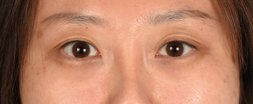 Hidden Patients Before & After Gallery - Patient 300838 - Image 1