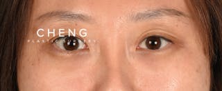 Hidden Patients Before & After Gallery - Patient 300838 - Image 1