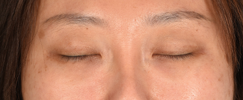 Hidden Patients Before & After Gallery - Patient 300838 - Image 3