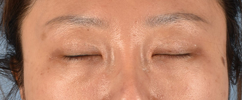 Hidden Patients Before & After Gallery - Patient 300838 - Image 4