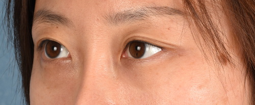 Hidden Patients Before & After Gallery - Patient 300838 - Image 5