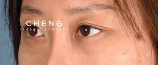 Hidden Patients Before & After Gallery - Patient 300838 - Image 5