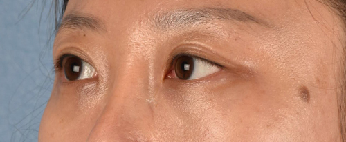 Hidden Patients Before & After Gallery - Patient 300838 - Image 6