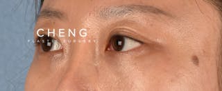 Hidden Patients Before & After Gallery - Patient 300838 - Image 6