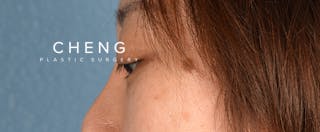 Hidden Patients Before & After Gallery - Patient 300838 - Image 7