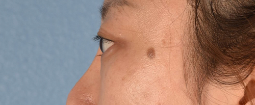 Hidden Patients Before & After Gallery - Patient 300838 - Image 8