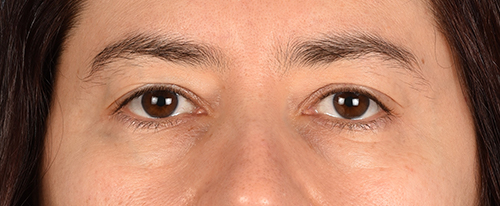 Hidden Patients Before & After Gallery - Patient 239841 - Image 1