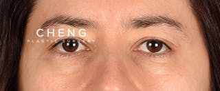 Hidden Patients Before & After Gallery - Patient 239841 - Image 1