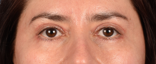 Hidden Patients Before & After Gallery - Patient 239841 - Image 2