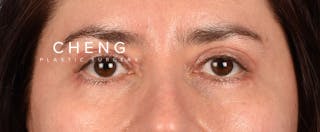 Hidden Patients Before & After Gallery - Patient 239841 - Image 2