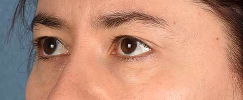 Hidden Patients Before & After Gallery - Patient 239841 - Image 3