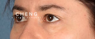 Hidden Patients Before & After Gallery - Patient 239841 - Image 3