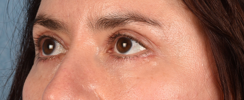 Hidden Patients Before & After Gallery - Patient 239841 - Image 4