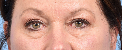 Hidden Patients Before & After Gallery - Patient 140219 - Image 1