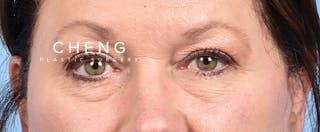 Hidden Patients Before & After Gallery - Patient 140219 - Image 1