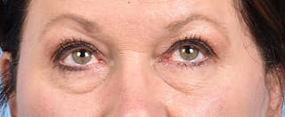 Hidden Patients Before & After Gallery - Patient 140219 - Image 2