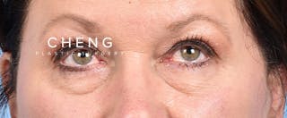 Hidden Patients Before & After Gallery - Patient 140219 - Image 2