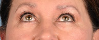 Hidden Patients Before & After Gallery - Patient 140219 - Image 3