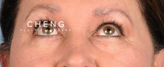 Hidden Patients Before & After Gallery - Patient 140219 - Image 3