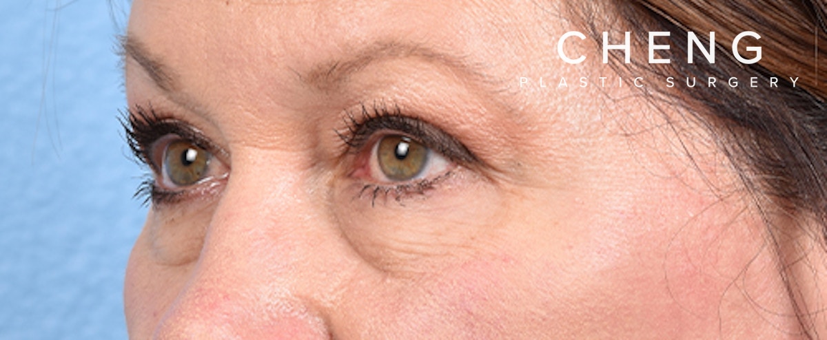 Hidden Patients Before & After Gallery - Patient 140219 - Image 4