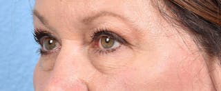 Hidden Patients Before & After Gallery - Patient 140219 - Image 4