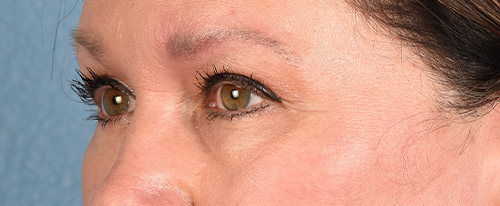 Hidden Patients Before & After Gallery - Patient 140219 - Image 5