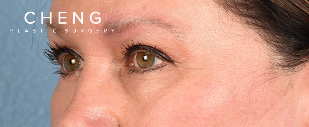 Hidden Patients Before & After Gallery - Patient 140219 - Image 5