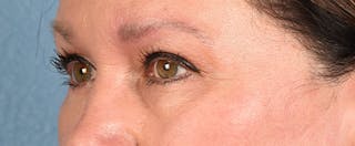 Hidden Patients Before & After Gallery - Patient 140219 - Image 5