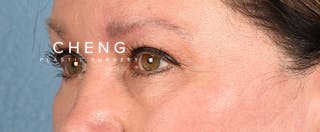 Hidden Patients Before & After Gallery - Patient 140219 - Image 5