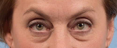 Hidden Patients Before & After Gallery - Patient 561726 - Image 1